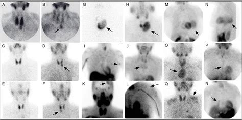 Frontiers | Parathyroid Imaging: Past, Present, and Future