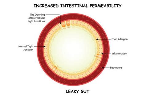 Increased Intestinal Permeability Design Graphic by hamjaiu · Creative ...