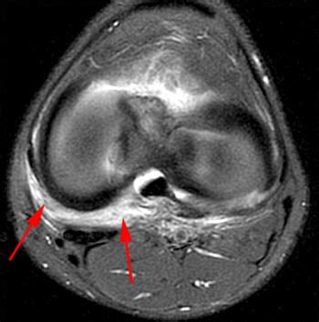 Posteromedial Corner Injury of the Knee - Radsource