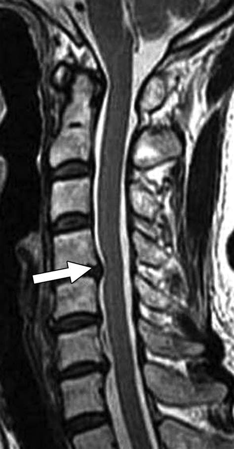 New Mri Grading System For The Cervical Canal Stenosis Semantic Scholar ...