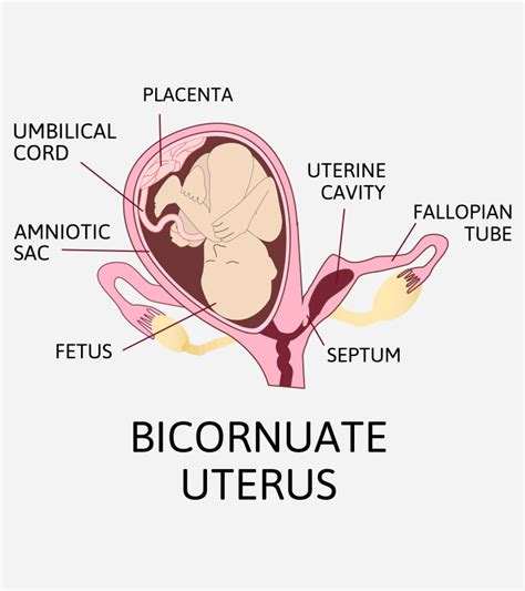 Bicornuate Uterus: Symptoms, Causes, Diagnosis, And Treatment – AbooBaby.com