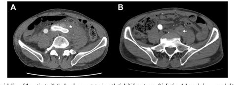 Figure 1 from Prosthetic vascular graft infection and prosthetic joint ...