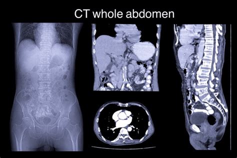 1,397 Abdomen Ct Scan Images, Stock Photos, 3D objects, & Vectors | Shutterstock