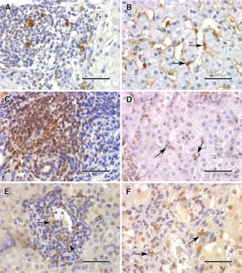 Immunohistochemical pictures of NK cells in HCV-infecte | Open-i