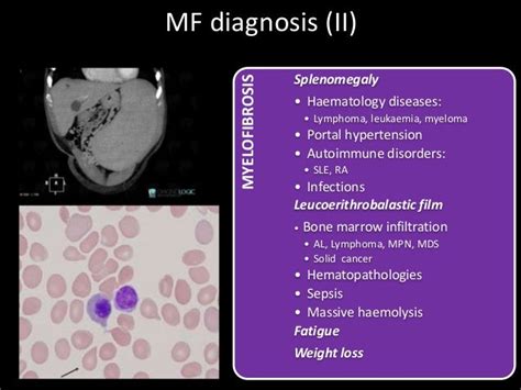 DIAGNOSIS AND MANAGEMENT OF MYELOPROLIFERATIVE NEOPLASMS