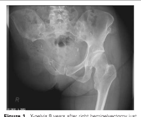 Spontaneous delivery after hemipelvectomy because of chondrosarcoma: a ...