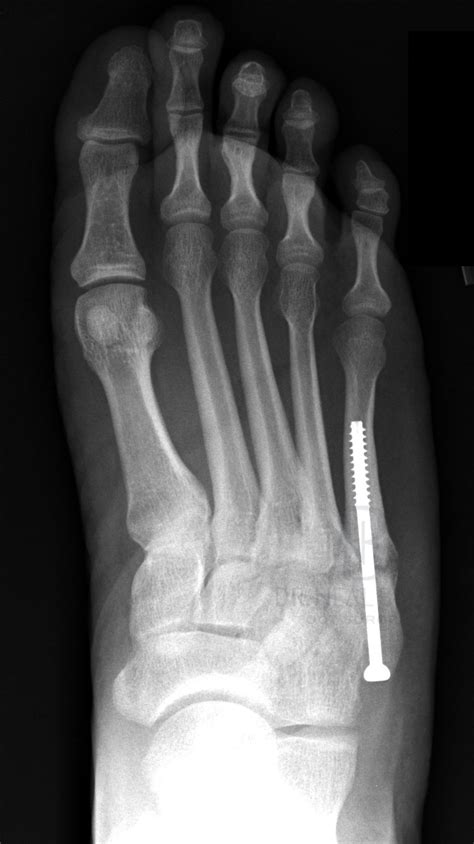 Fifth Metatarsal Fracture Treatment And Tips / Metatarsal Fractures ...