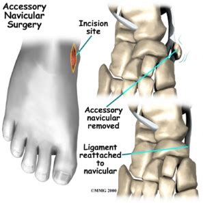 Accessory Navicular Bone - Physiopedia