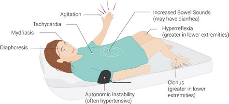 Clonus Article - StatPearls