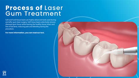 Laser Gum Treatment in Antalya - Akar Dental