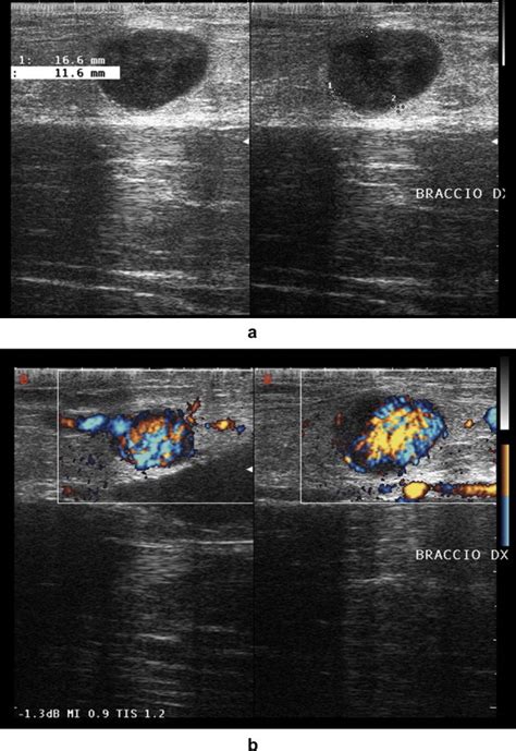 Epitrochlear lymph nodes: Anatomy, clinical aspects, and sonography ...