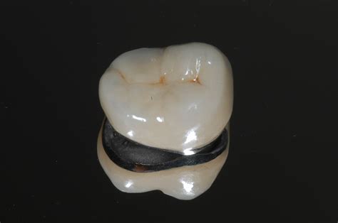 Services: Porcelain Crowns | Brisbane Prosthodontics