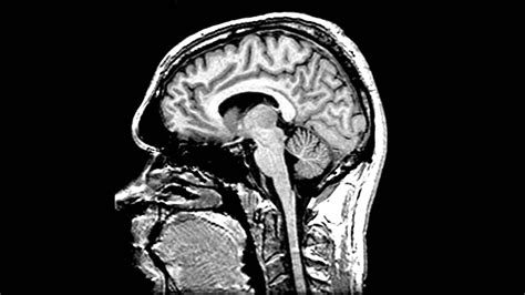 Sagittal Plane Brain Diagram