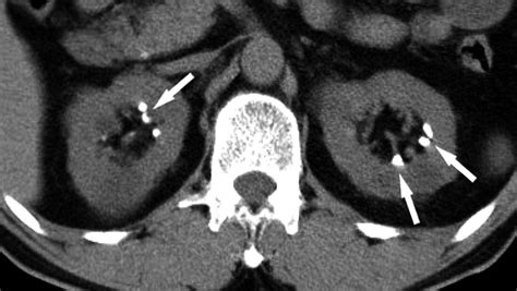 Renal Papillary Necrosis: Review and Comparison of Findings at Multi–Detector Row CT and ...