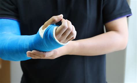 How Long Does a Cast Stay On? | Pomona Valley Health Centers