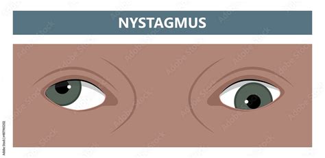 miosis eye pupil size iris retina brain Horner miotic muscle dilated ...