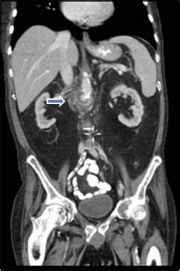 black spots on ct scan of abdomen and pelvis