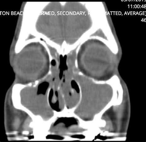 Chronic Sinusitis Case Study: N.X. Nguyen, M.D.: Otolaryngology