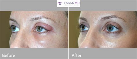 Eyelid Chalazion Surgery Before and After Gallery | Taban MD