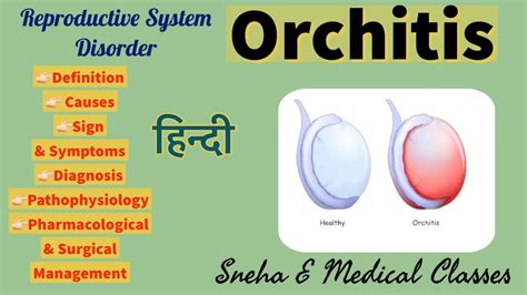 Orchitis !! causes !! Sign & Symptoms!! Pathophysiology!! Diagnosis!! Management!! Hindi ...