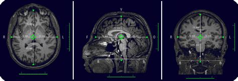 Atlas | JHP MRI Brain Atlas