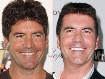 Simon Cowell Celebrity Teeth, Celebrity Smiles, Dental Makeover, Perfect Teeth, Dental Veneers ...