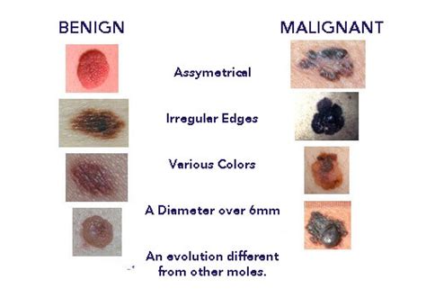 Some Facts About Moles - Anatomy and physiology - Step To Health