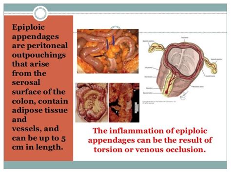 Acute epiploeic appendagitis.pptx2