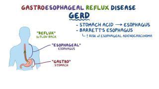 Schatzki Ring: What Is It, Causes, Treatment, and More | Osmosis