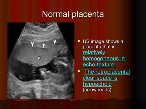 How do you know which side the placenta is on?