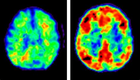 All you need to know about brain scans and dementia - Alzheimer's Research UK