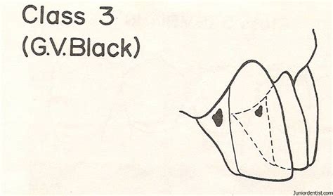 Dental Caries GV Black Classification of Carious Lesions