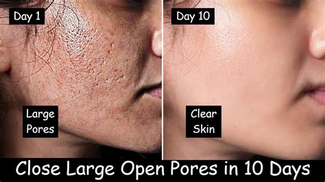 She Closed Large OPEN PORES in 10 Days - Remove Dark Spots | Rice Ice ...