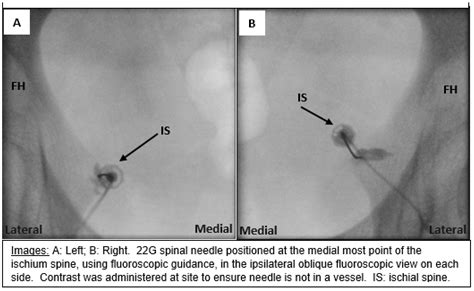 JCM | Free Full-Text | Fluoroscopy-Guided Transgluteal Pudendal Nerve ...