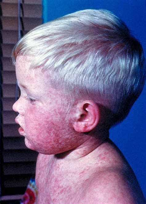 Measles Rash Images To Help Identify Symptoms as Virus Spreads in US