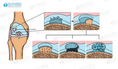 Cartilage Regeneration Singapore: Benefits, Risks & Recovery