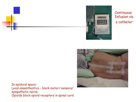 PPT - Epidural vs IV PCA PowerPoint Presentation, free download - ID:241134