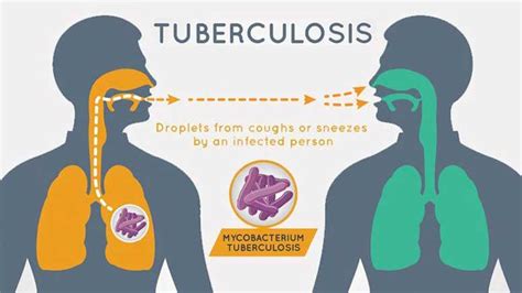 Tuberculosis Symptoms & Signs – Entirely Health