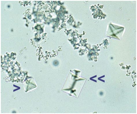 Calcium Oxalate Dihydrate Crystals In Urine