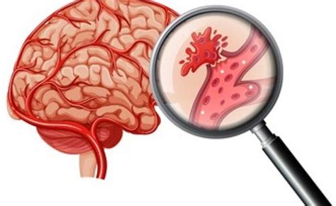 What Is A Hemorrhagic Stroke? Causes, Risk Factors, And Treatment ...