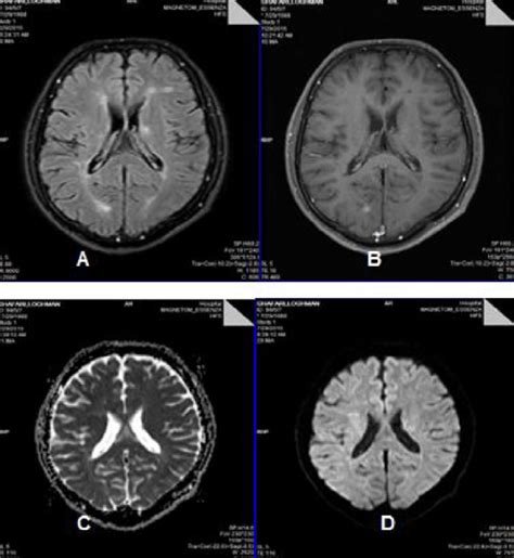 An active MS plaque in occipital lobe with four MRI pulse sequence: A)... | Download Scientific ...