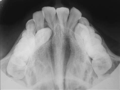 OCCLUSAL RADIOGRAPH 16 | buyxraysonline