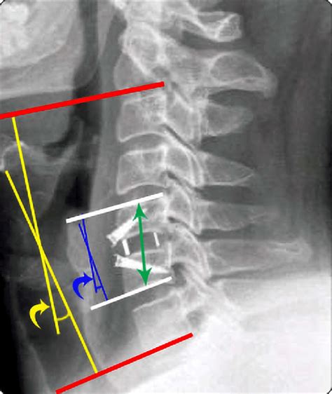 Demonstration of the measurements of the Cobb-C angle: yellowish arrow,... | Download Scientific ...