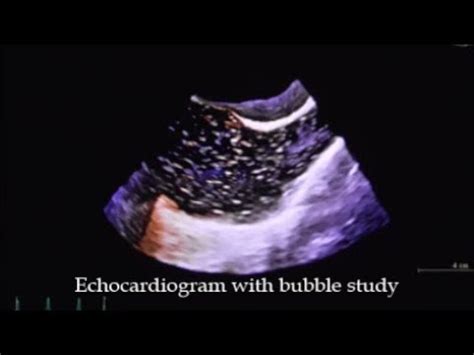 2D echo: bubble study | Doovi