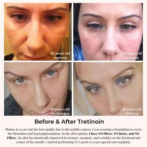 Tretinoin Before And After