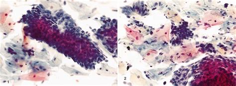 Crowded, disorganized fragments with peripheral feathering and nuclear... | Download Scientific ...