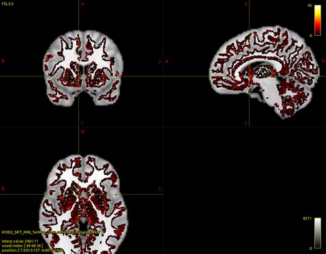 Global tractography results are not good - tractography - MRtrix3 Community