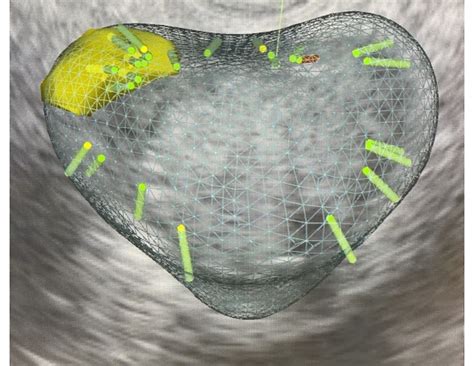 KOELIS® MRI Fusion Biopsy System Introduced at UNC Health | Department ...