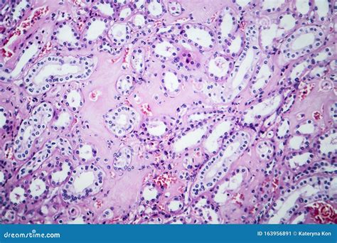 Histopathology of Hypertensive Renal Disease, Light Micrograph Stock Image - Image of pressure ...