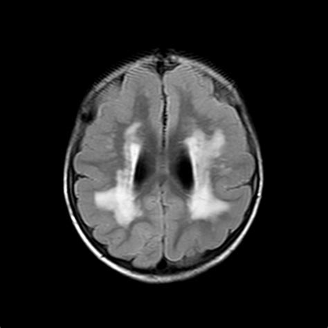 Lissencephaly-MRI - Sumer's Radiology Blog